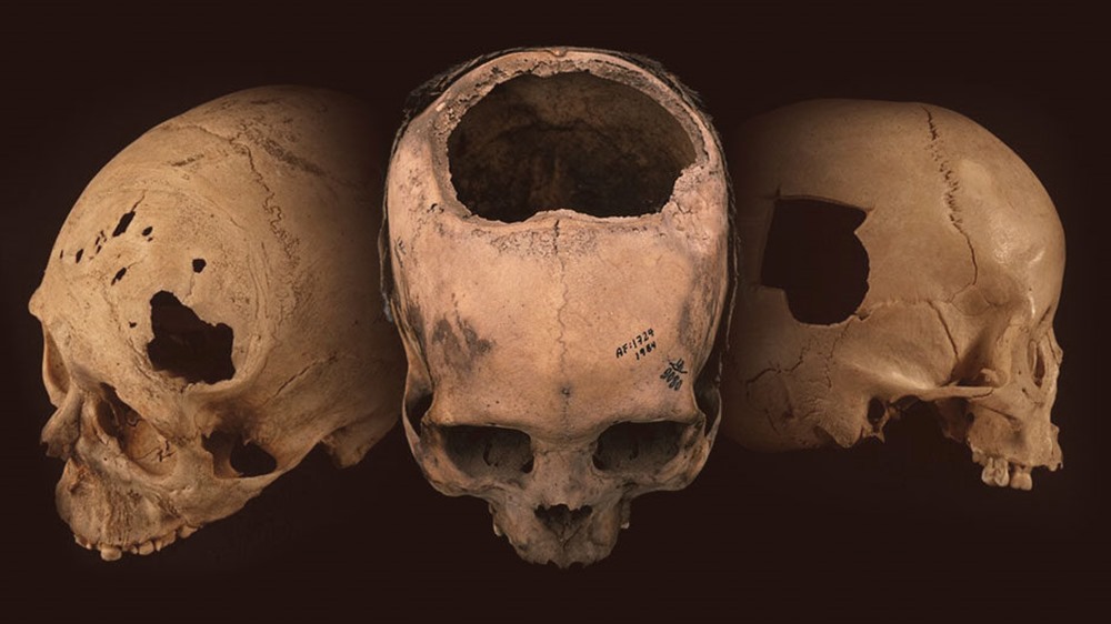 Les Incas étaient vraiment très bons à percer des trous dans le crâne de leurs congénères