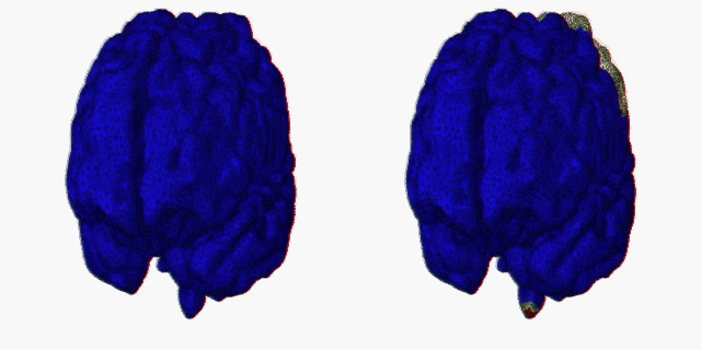 Un modèle informatique simule la façon dont la maladie d’Alzheimer se propage dans le cerveau