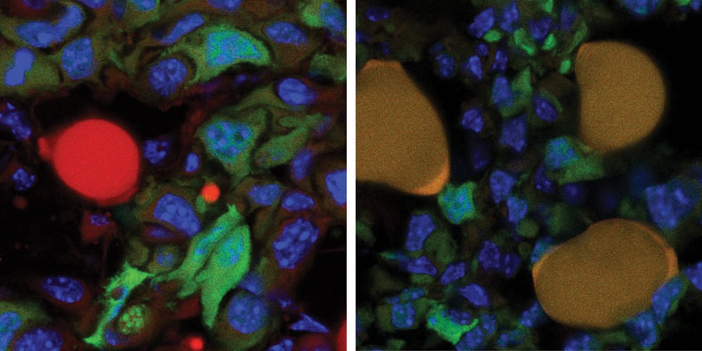 Une méthode pour convertir les cellules cancéreuses en cellules graisseuses pourrait bloquer la propagation du cancer