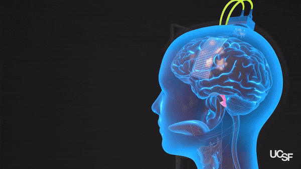 Un nouvel implant cérébral permet à une patiente paralysée de communiquer par l’intermédiaire d’un avatar numérique