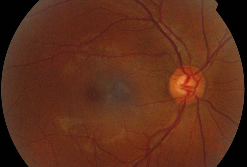 Des photos de l’œil, analysées par une IA, permettent de rapidement diagnostiquer l’autisme infantile avec une précision de 100 %