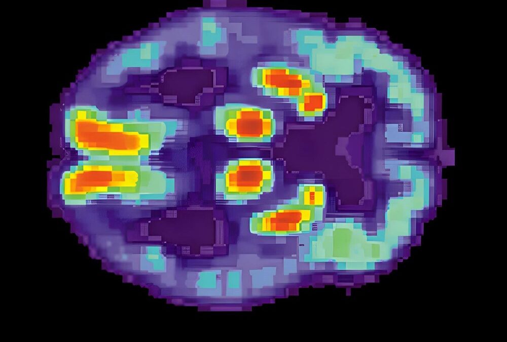 Des scientifiques trouvent des preuves de la transmissibilité de la maladie d’Alzheimer par le biais d’une ancienne procédure médicale