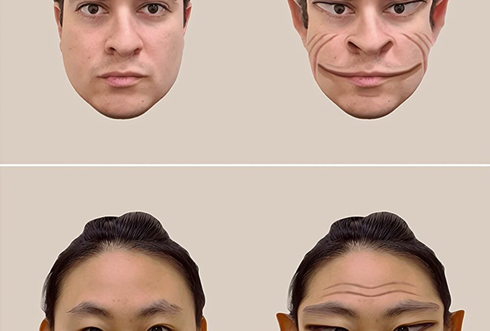 Cette maladie neurologique extrêmement rare fait apparaître les visages étrangement déformés