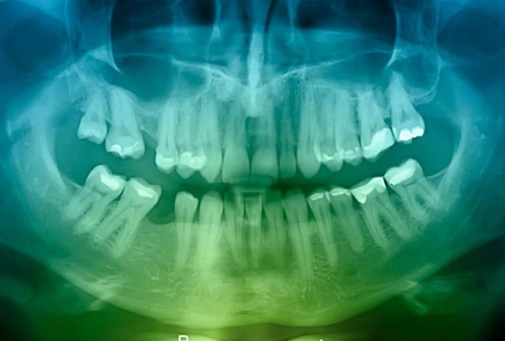 Cernes dentaires : nos dents présentent les plus importants événements biologiques de notre vie