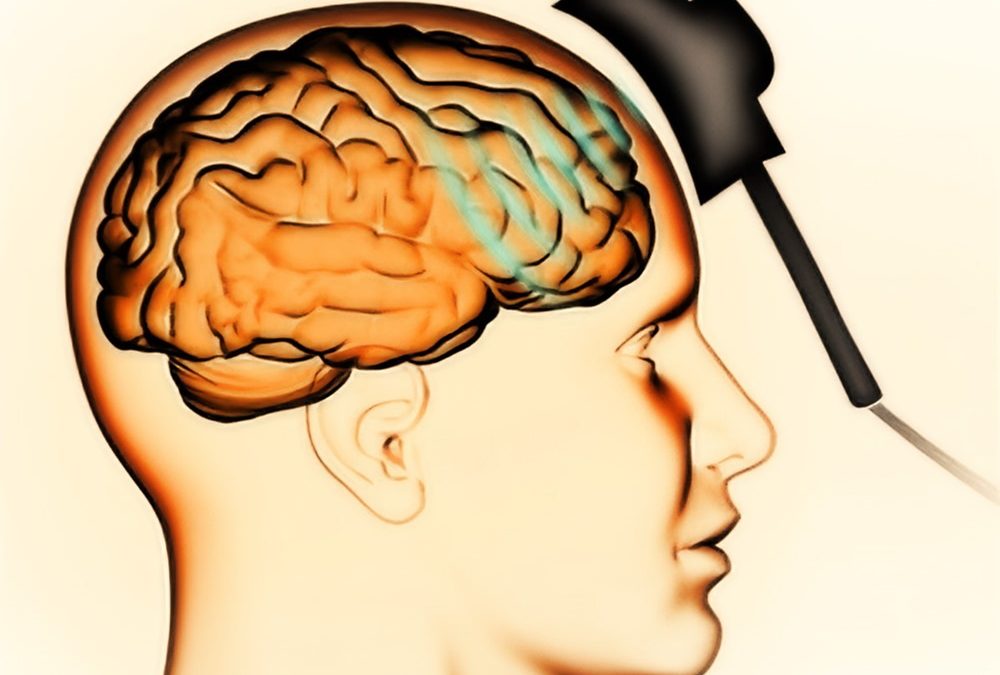Une nouvelle méthode de stimulation magnétique du cerveau promet de traiter les cas de sévère dépression