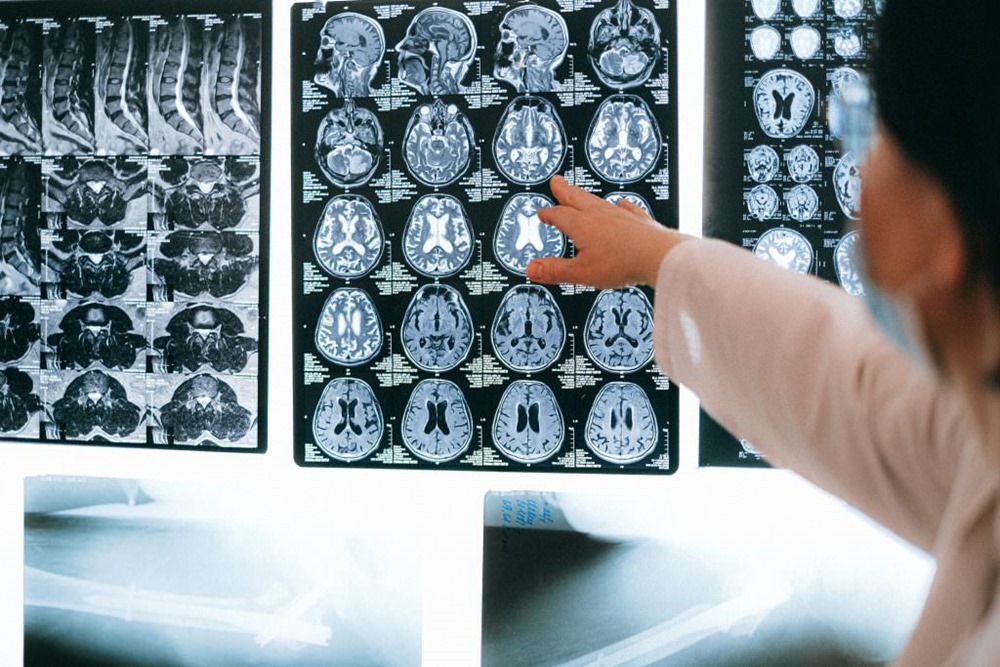 Un outil d’apprentissage automatique capable de détecter les premiers signes de la maladie d’Alzheimer avec une précision de 99 %