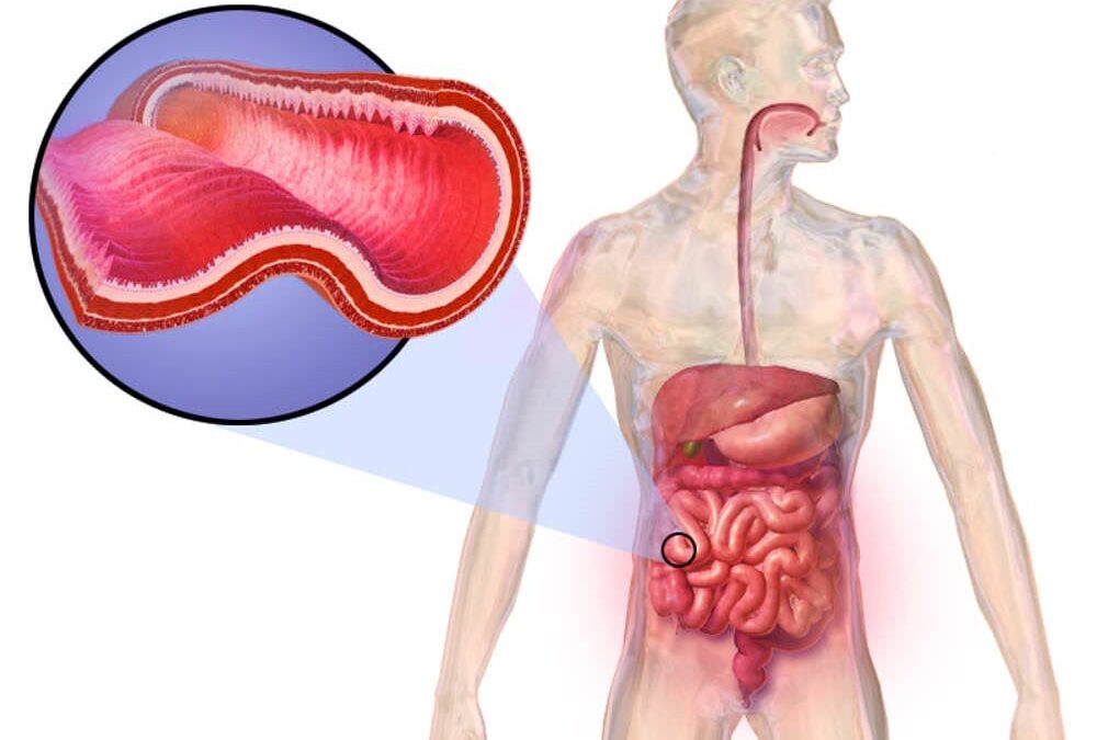 79 % des patients atteints de la maladie de Crohn sont en rémission après un traitement anticipé
